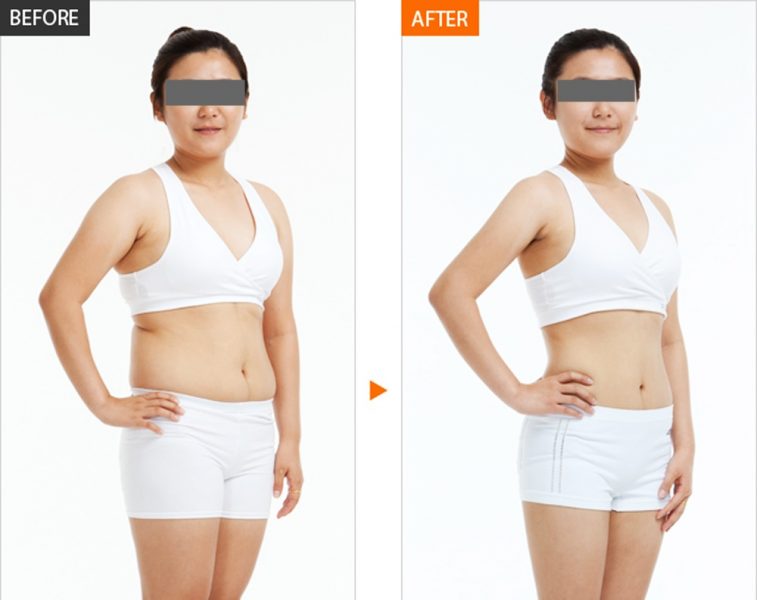 Những ưu điểm và kết quả sau khi tiêm giảm béo