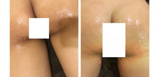 Kết quả sau liệu trình điều trị thâm-Thâm mông