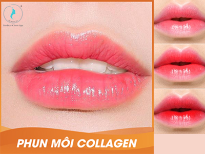 Phun môi collagen - Sở hữu ngay đôi môi căng mọng, quyến rũ và cuốn hút nhất
