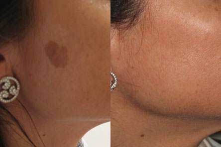 Xóa chàm bớt bẩm sinh không còn quá khó