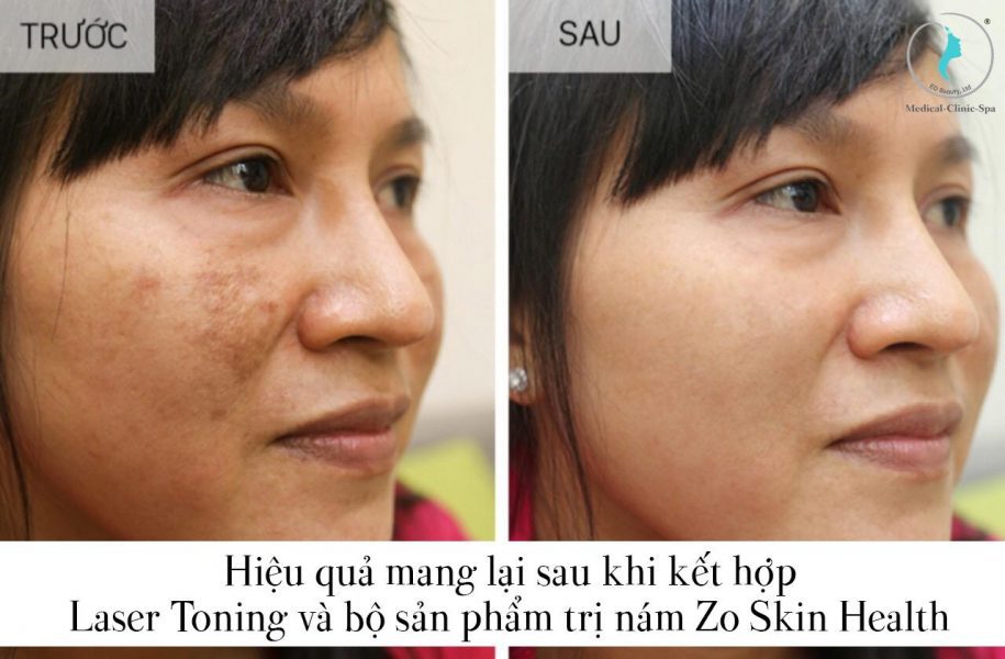 Kết quả sau khi kết hợp Laser Toning và bộ sản phẩm trị nám Zo Skin Health