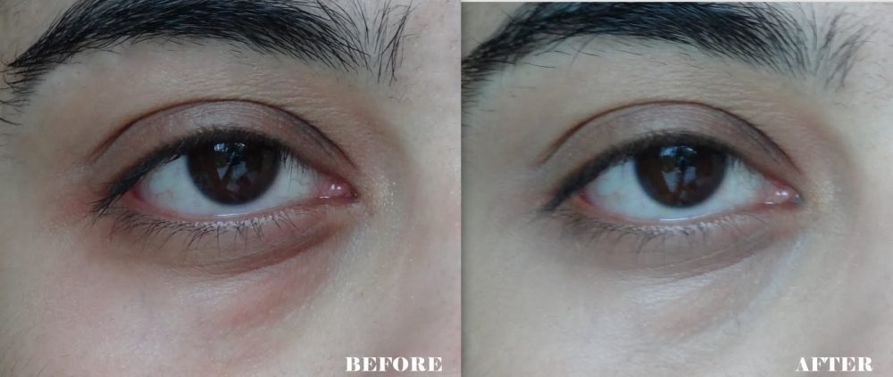 Hiệu quả của dịch vụ tiêm meso điều trị thâm mắt tại ED Beauty Spa