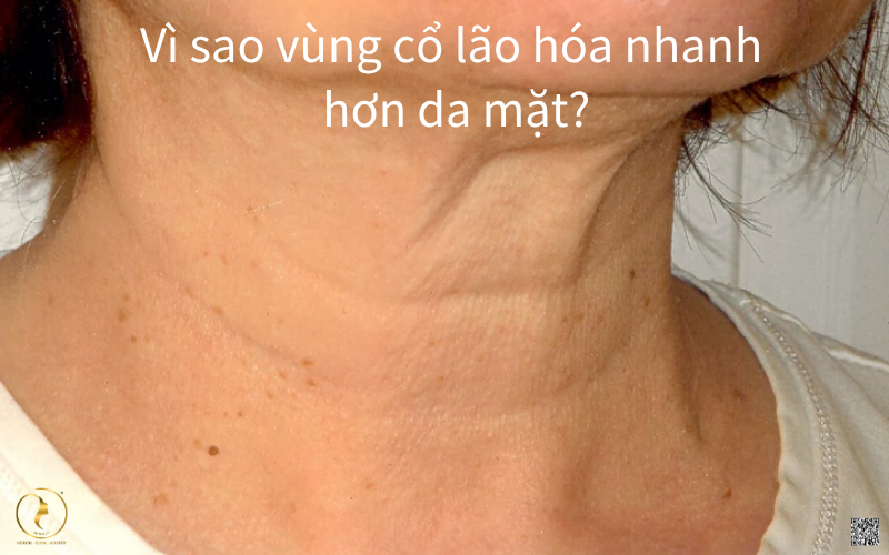 Vì sao vùng cổ lão hóa nhanh hơn da mặt?